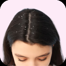 Dandruff